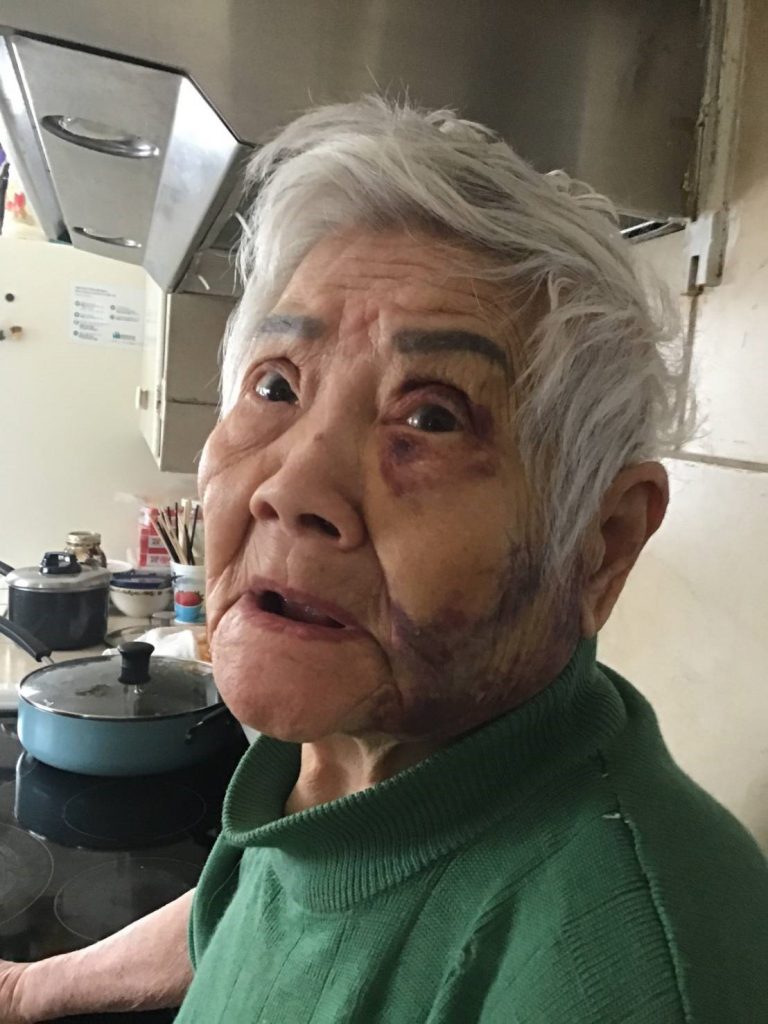 圖片說明：張姓婦人因被兩代至交侵佔賴以為生的退休金，窮困到只吃稀飯配鹹菜度日，導致營養不良，日前在家中跌倒。