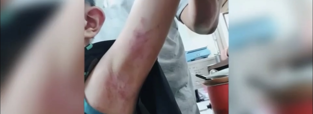 特教孩子手臂上有大片瘀青。（記者徐煜勝翻攝）