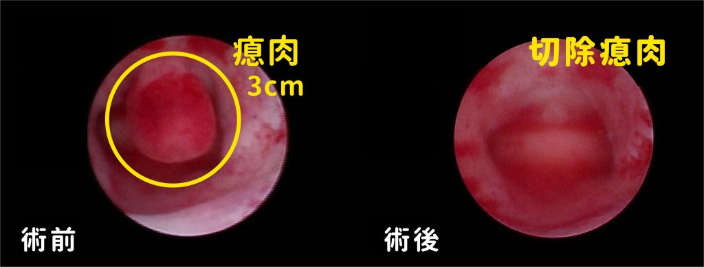 吳秉忠醫師指出，子宮瘜肉好發於30~60歲女性，以40~50歲發生率最高。（圖/記者林照東翻攝）