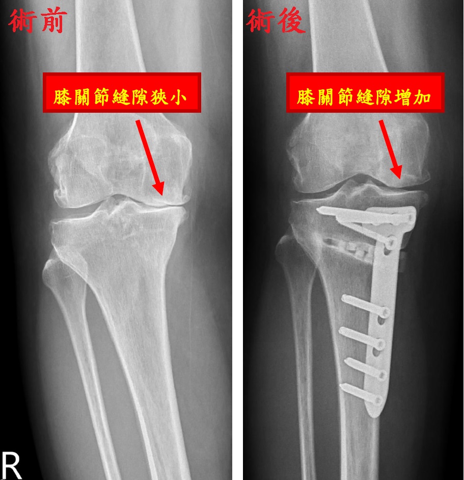 陳威仁醫師表示，高位脛骨矯正手術前需X光及3D掃描，精確計劃後進行切割與固定，矯正O型腿，分散壓力，減輕疼痛並延長膝關節壽命。（圖/記者林照東翻攝）
