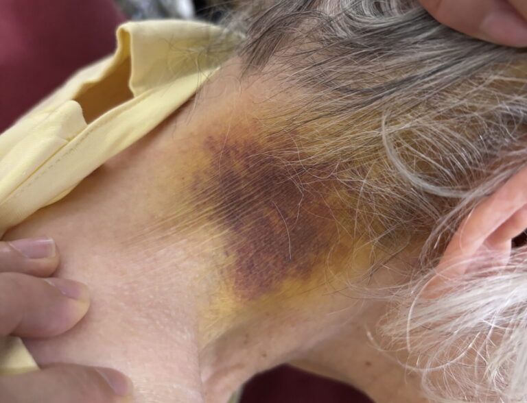 安養人陳姓老婦人於青松長照烏日住宿型機構內廁所不明原因跌倒,後腦直接撞擊地面,造成頭皮撕裂傷與全頭部、頸部多處大片瘀血。(圖/家屬提供)