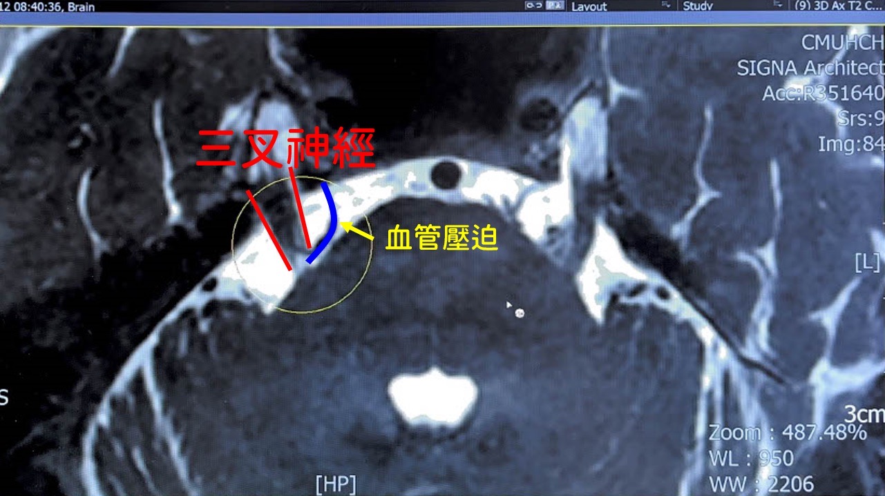 MRI影像清楚顯示三叉神經（紅色）受到鄰近血管（藍色）擠壓，為導致患者反覆臉部劇痛的根本原因，醫師針對此處進行顯微減壓手術，術後症狀明顯改善。（圖/記者張家燁翻攝）