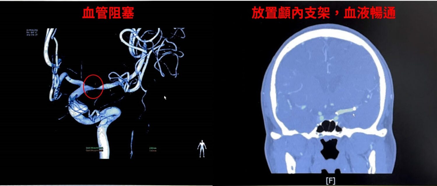 左圖顯示患者顱內中大腦動脈血管嚴重狹窄情形（紅圈處），右圖為支架置放術後影像，血流恢復順暢，顯示治療成功並有效預防再次中風。（圖/記者張家燁翻攝）