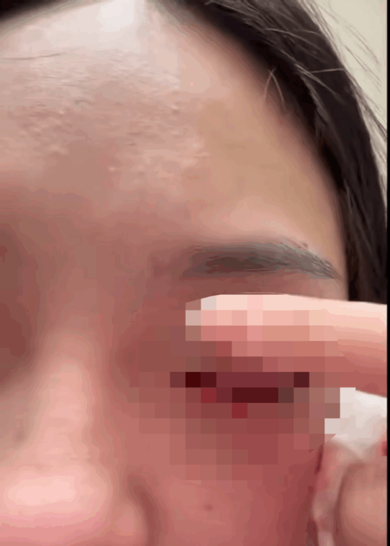 李女遭鄭男失控爆擊後，當場左眼血流如注，水晶體脫落。（圖：投訴者提供）