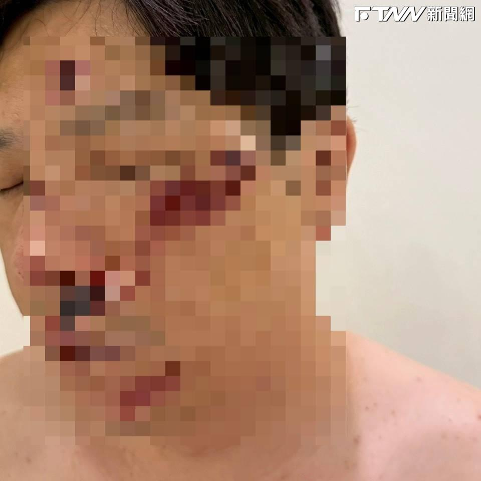 廖承豪臉部多處遭到毆傷。（圖/民眾提供）