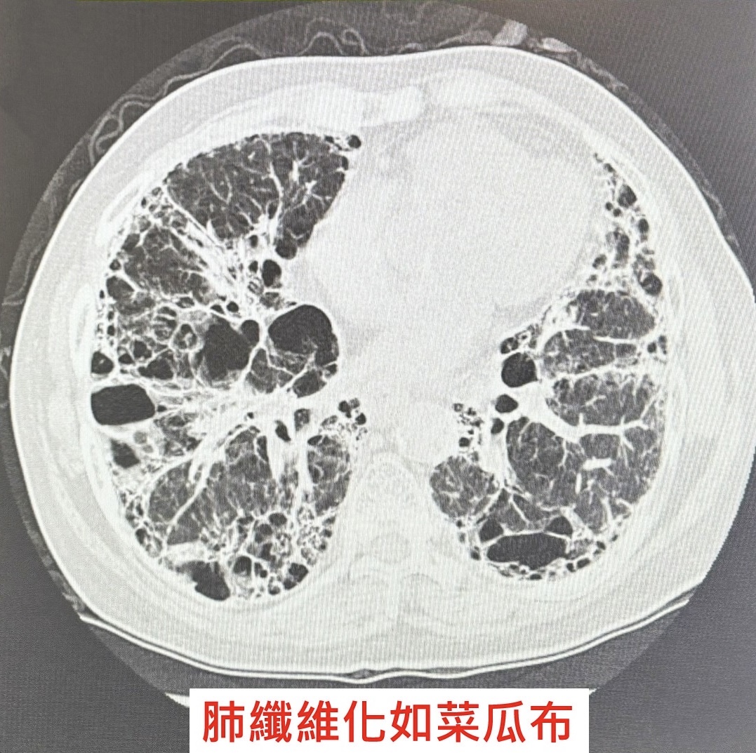  肺部電腦斷層影像顯示肺纖維化情形，肺組織呈現如「菜瓜布」般纖維化變化。（圖／記者張家燁翻攝）